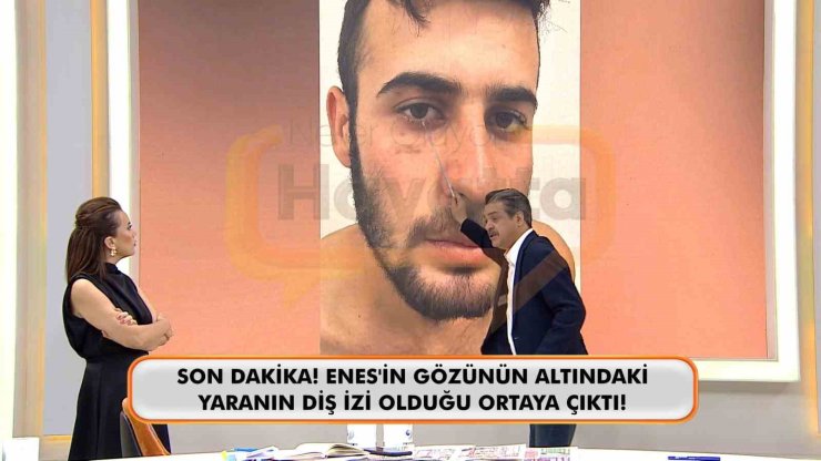 CANLI YAYINDA ENES GÜRAN’IN GÖZÜNÜN ALTINDAKİ DİŞ İZİNE DİKKAT ÇEKİLDİ